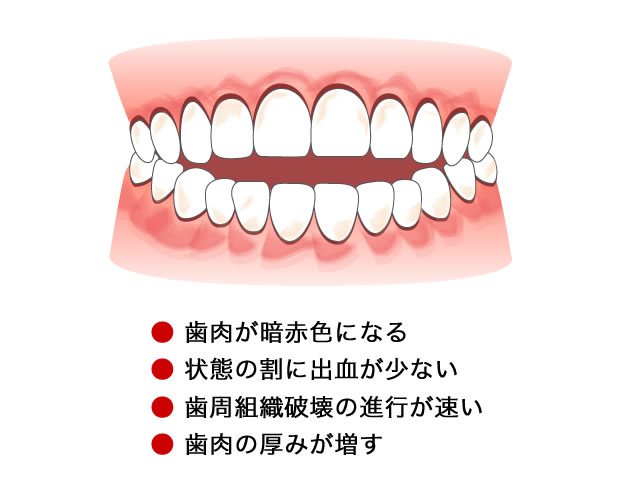 喫煙と歯周病の関係 Vol.01